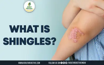 Understanding Shingles: Causes, Symptoms, and Treatment