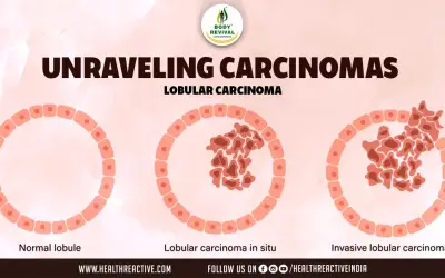 Understanding the Most Common Type of Cancer