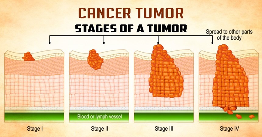Tumor Treatment without surgery