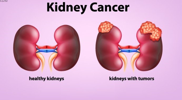 Kidney cancer Image