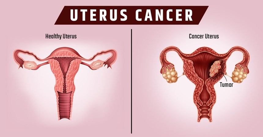 Uterus cancer treatment