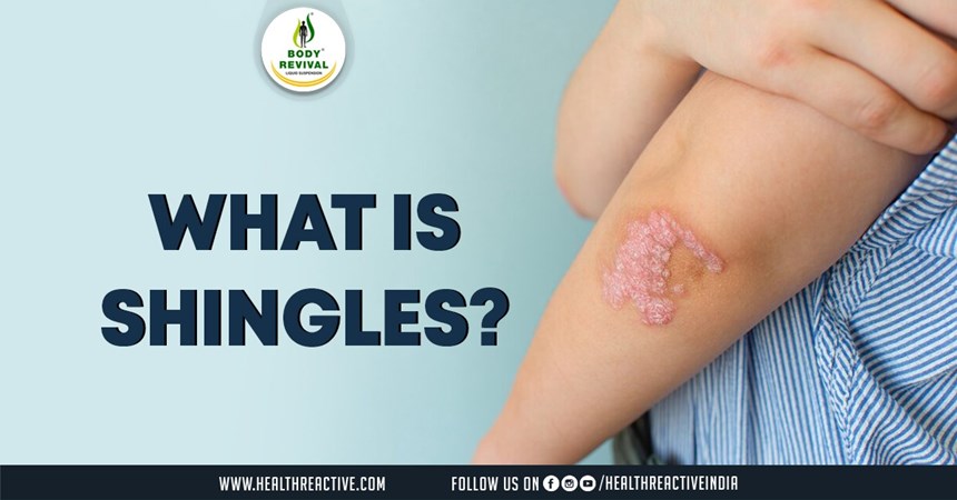 Understanding Shingles: Causes, Symptoms, and Treatment